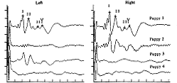 Deafness Scan